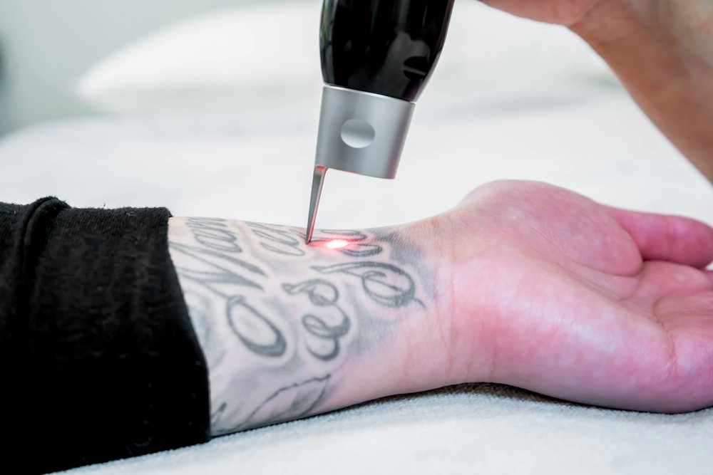 Tattoo Removal Las Vegas Tattoo Removal Las Vegas